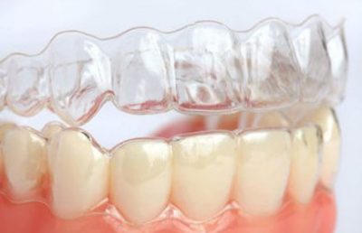 Aparelho dental Invisalign em Itapema SC
