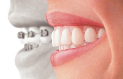Aparelho dentário invisalign em Itapema SC