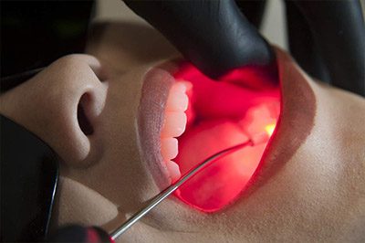 Laserterapia odontológica em Itapema SC
